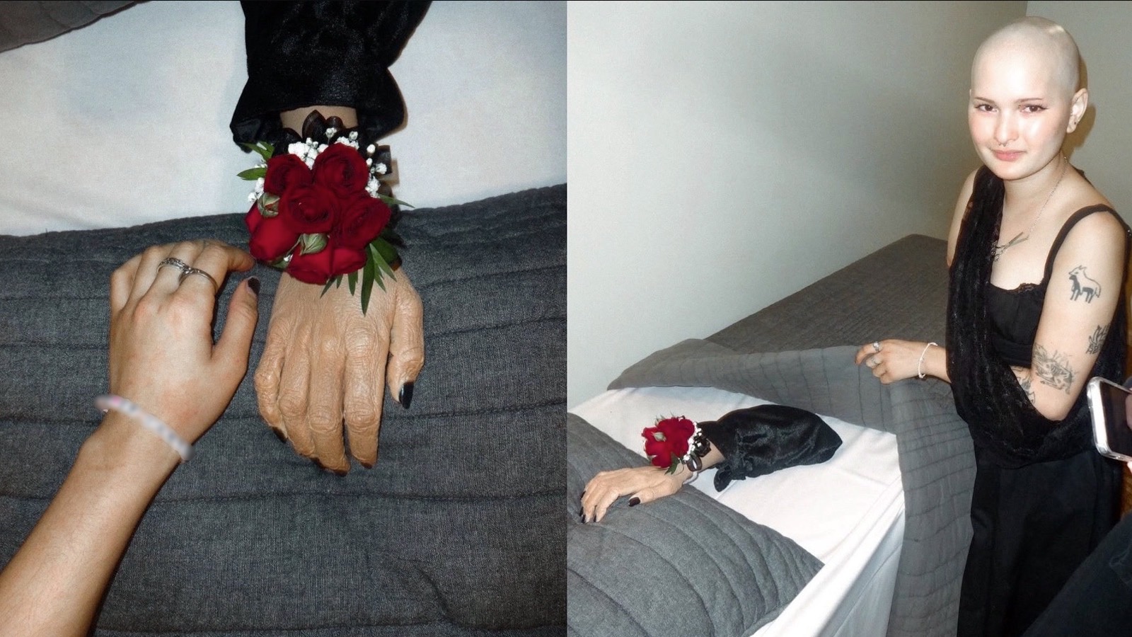 TikToker Holds Funeral for Amputated Arm to Process Life-Altering Journey